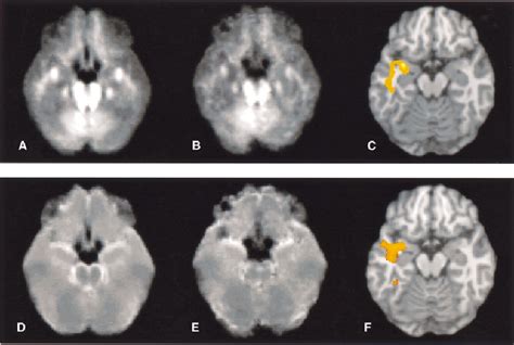 Left temporal lobe epilepsy group with normal conventional MRI. ( A and ...