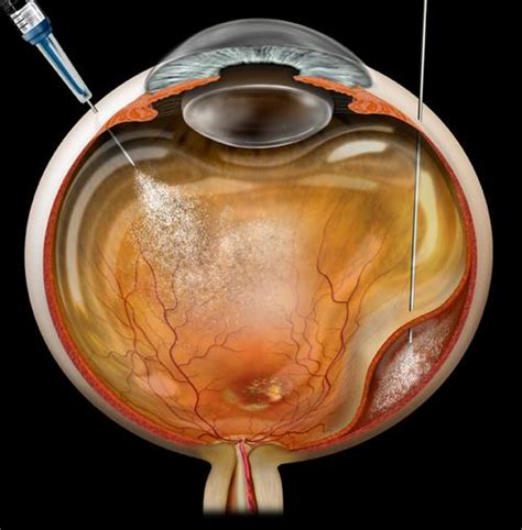 Gas Bubble Retina Surgery