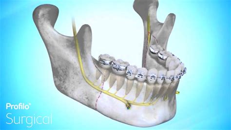 Bsso Lower Jaw Advancement Surgery Youtube