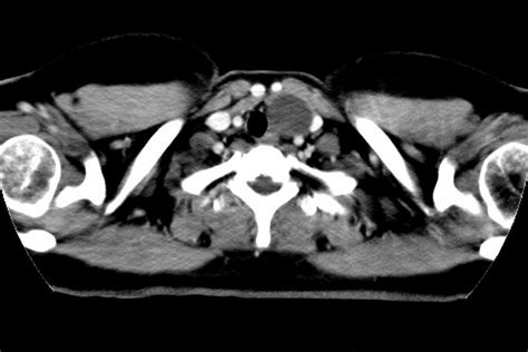 Thymic Cysts Pacs