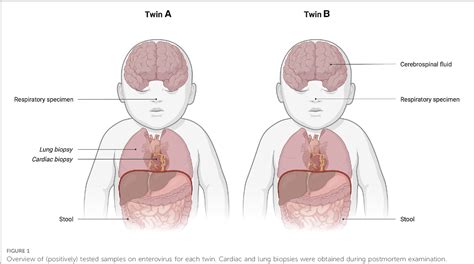 Figure 1 From Severe Neonatal Enterovirus Infection In Twins With