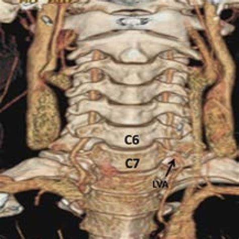 Origin Of Left Vertebral Artery Lva From Aortic Arch Aa Lsca Left