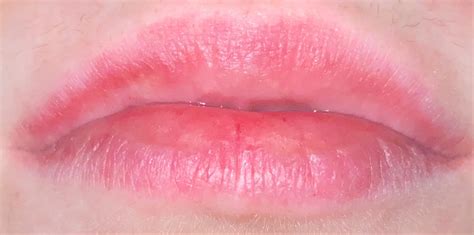 I get this red line across my *top* lip and it really burns / tingles