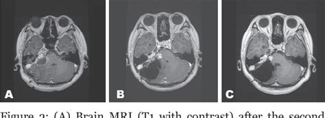 Figure 2 From A Case Of Delayed Tension Pneumocephalus Nine Years After