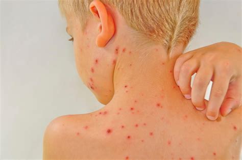 5 Home Remedies For Chickenpox Fox News