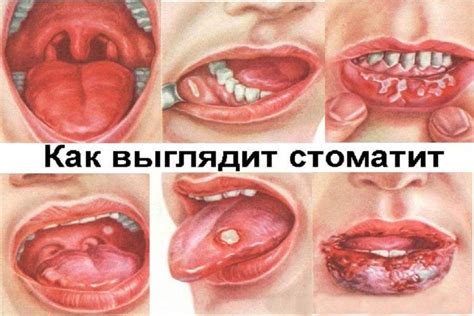 Лекарства перед операцией - SinusLifting.ru