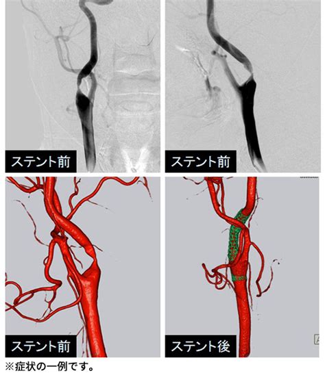 頸動脈狭窄症 Carotid Artery Stenosis Japaneseclass Jp