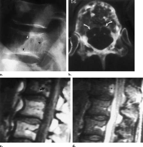 Mixed Lytic And Blastic Paget Disease Of The Spine Simulating Malignant