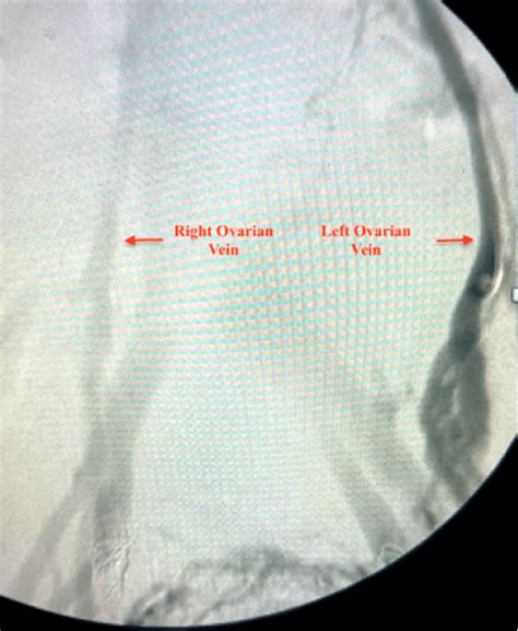 Catheterization Of The Left Ovarian Vein With After Contrast Injection