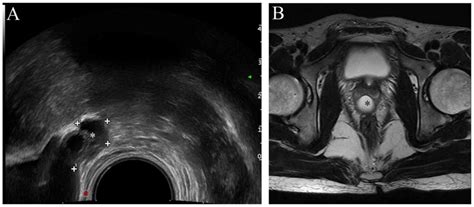 Treatment Of Mullerian Duct Cyst By Combination Of Transurethral