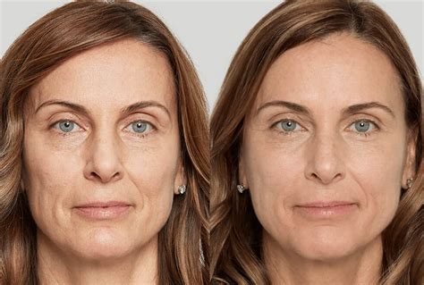 Sculptra Bergstrom Aesthetics