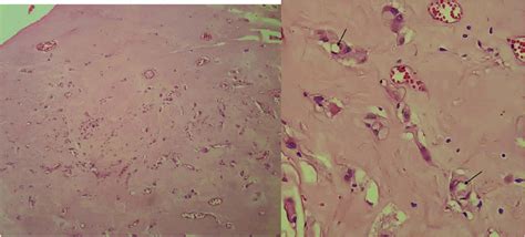 Scielo Brasil Primary Intraoral Epithelioid Hemangioendothelioma Of