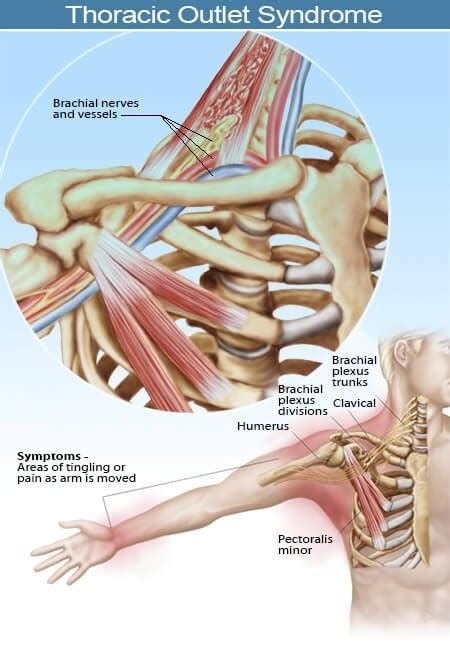 Case Study Thoracic Outlet Syndrome John Donohie Cmt