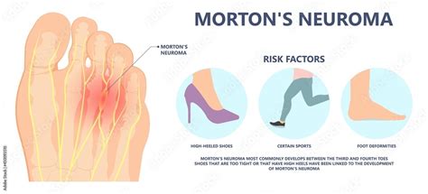 Plakat Morton S Neuroma Pain Foot Ball Toe Shoe Tissue Nerve High Heel