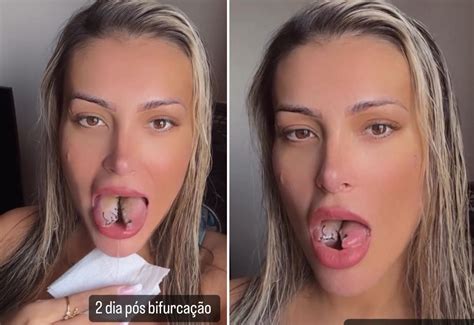 Lingua Com Corte No Meio - Andressa Urach mostra recuperação de língua dividida ao meio: 'Não ...