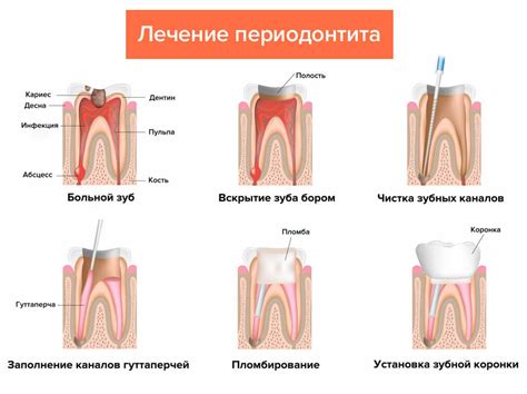 Периодонтит зуба. Причины, виды, симптомы, лечение, профилактика ...