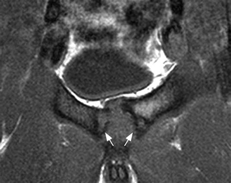 Athletic Pubalgia And Sports Hernia Optimal MR Imaging Technique And