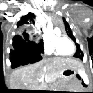 Chest Computed Tomography Angiogram Demonstrates A Macrocystic