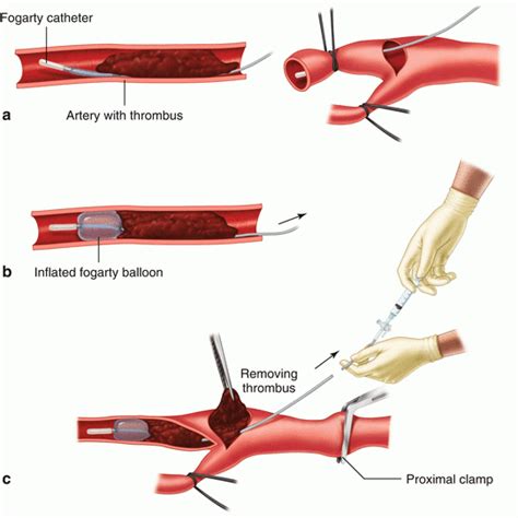 Peripheral Arterial Thrombosis Emboli Thoracic Key