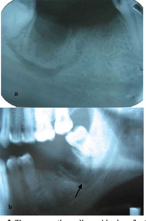 [pdf] Localized Osteomyelitis Of The Mandible Secondary To Dental Treatment Report Of A Case