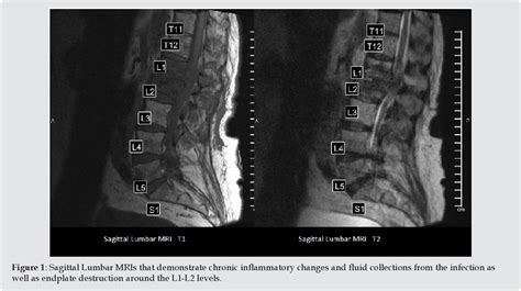 Figure From Radiographic Evidence Of An Epidural And Paraspinal