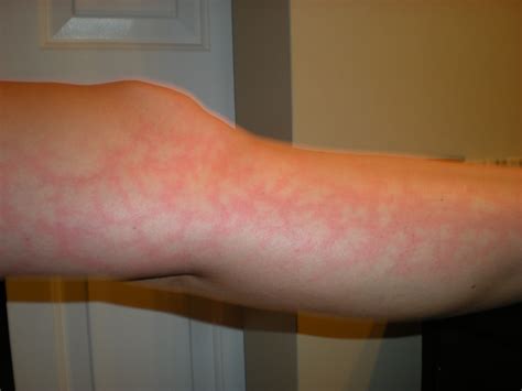 Weird Rash On My Leg