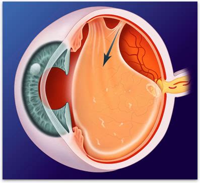 Posterior Vitreous Floaters