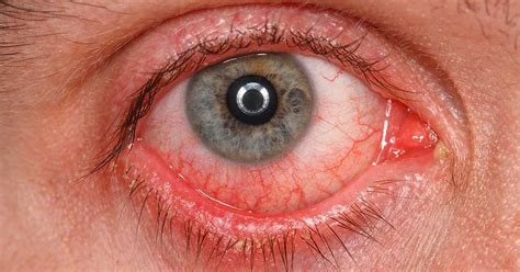 Lacrimal Caruncle Swollen Itchy Infection Cyst Health Care Tips