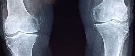 Can Stem Cells Regrow Knee Cartilage