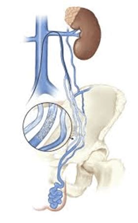 Varicocele Embolization Fredericksburg Varicocelectomy Fairfax