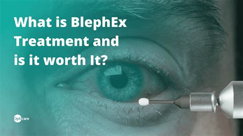 Relieve Blepharitis Symptoms With Blephex Opticare Opticians