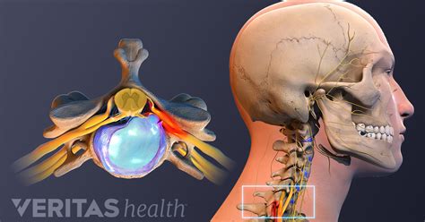 Slipped Disc Symptoms Neck at Rudolph Miller blog
