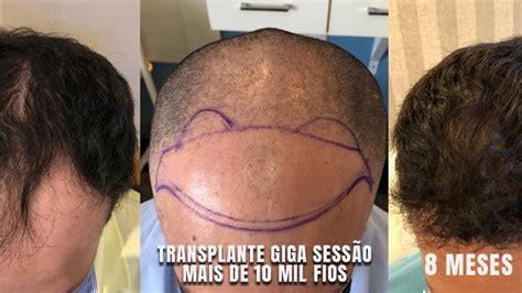 Antes e depois de transplante capilar FUE em ribeirão preto