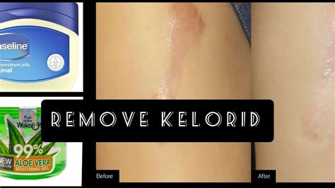 Effective Remedies To Remove Keloid Scars Naturally Youtube