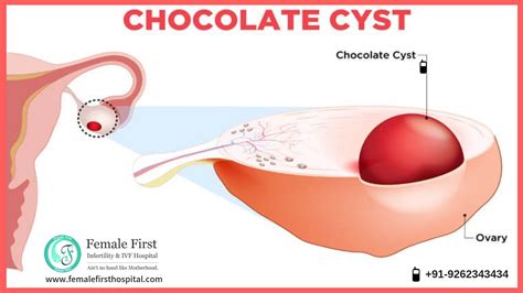 Chocolate Ovarian Cyst