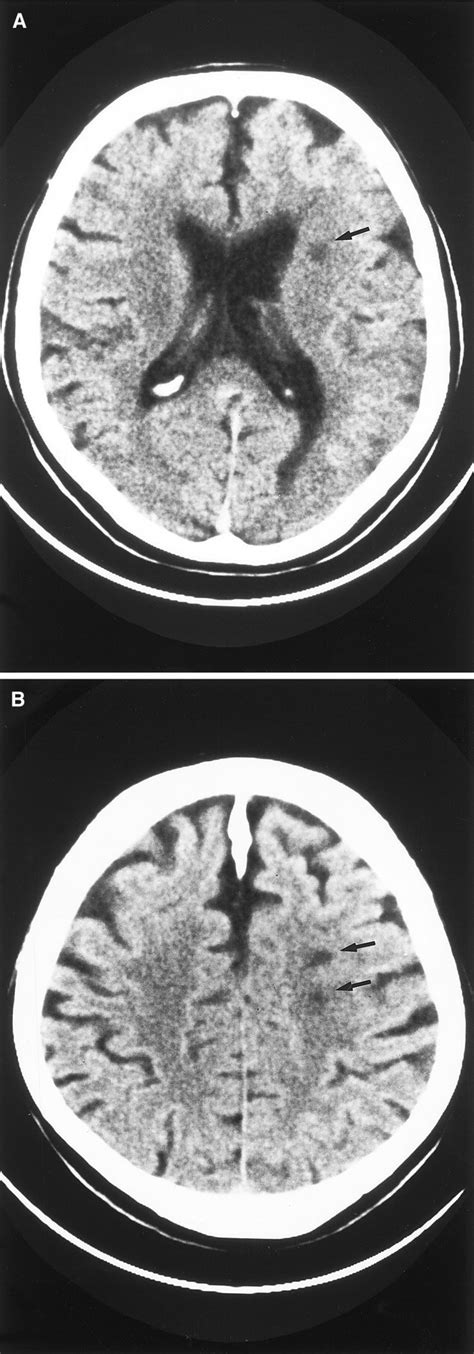 Internal Borderzone Infarction Stroke