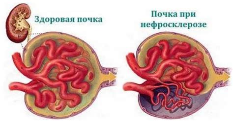 Лечение нефросклероза в Хабаровске - Медикъ