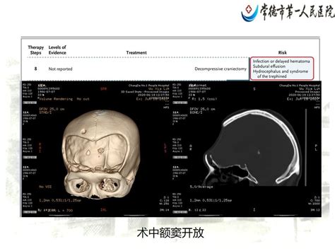 监测有道丨颅压监测下1例重型脑外伤的救治——颅脑创伤 神经重症周刊（第199期） 脑医汇 神外资讯 神介资讯