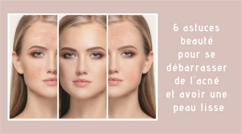 Astuces Beaut Pour Se D Barrasser De L Acn Et Avoir Une Peau Lisse