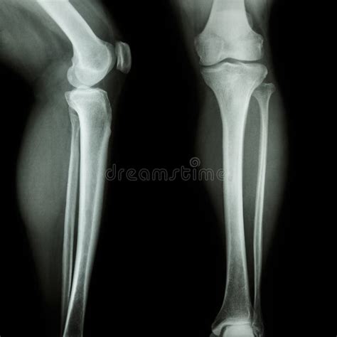 Film X Ray Leg Knee Ap Lateral Stock Photo Image