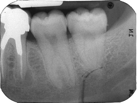 Taurodontism – Dr. G's Toothpix