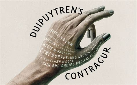 understanding dupuytrens contracture symptoms  treatment