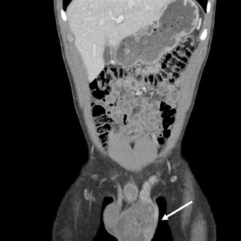 Computerized Tomography Scan Of The Abdomen And Pelvis With Contrast