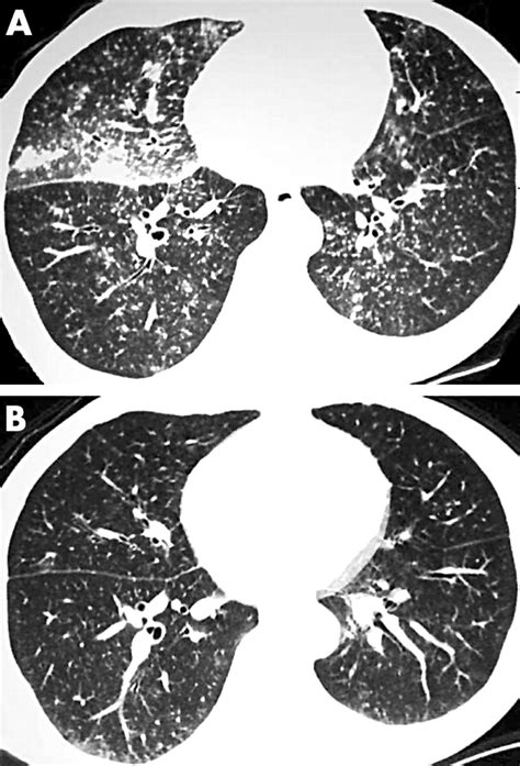 Resolution Of Lymphocytic Interstitial Pneumonitis In An Hiv Infected