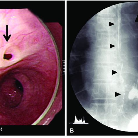 Follow Up Upper Gastrointestinal Endoscopy A At The Mid Esophagus