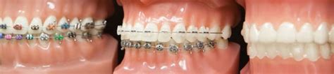 Our Services Orthodontist In Henderson Nv Braces And Invisalign