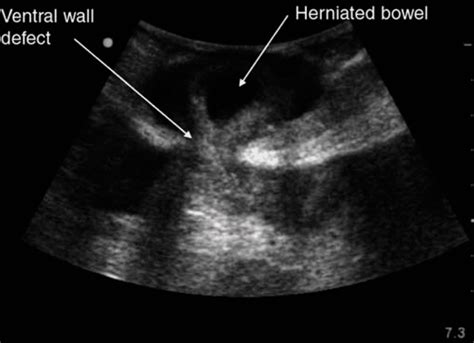 Ventral Abdominal Hernia Ultrasound