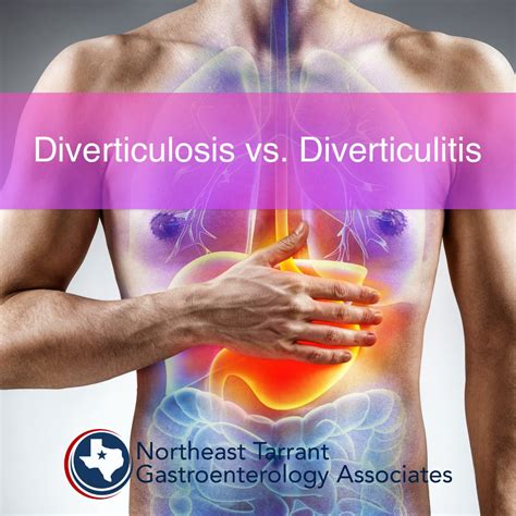 Diverticulitis Symptoms And Causes