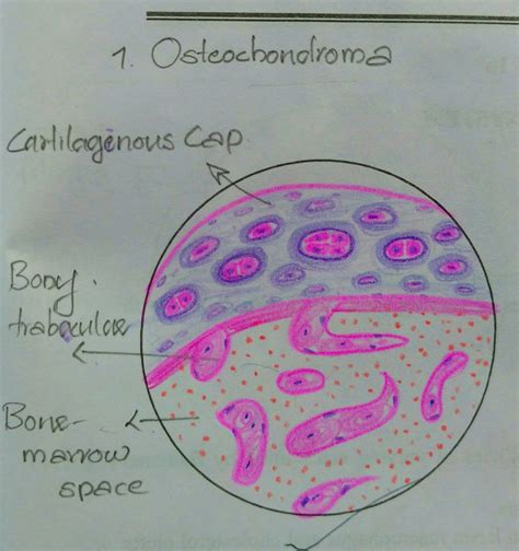 Histopathology Drawings: Osteochondroma