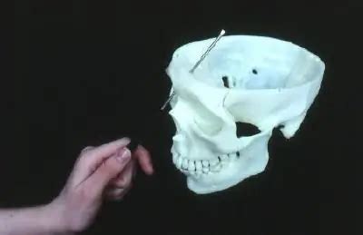 What is a lobotomy or leucotomy? | Medicine